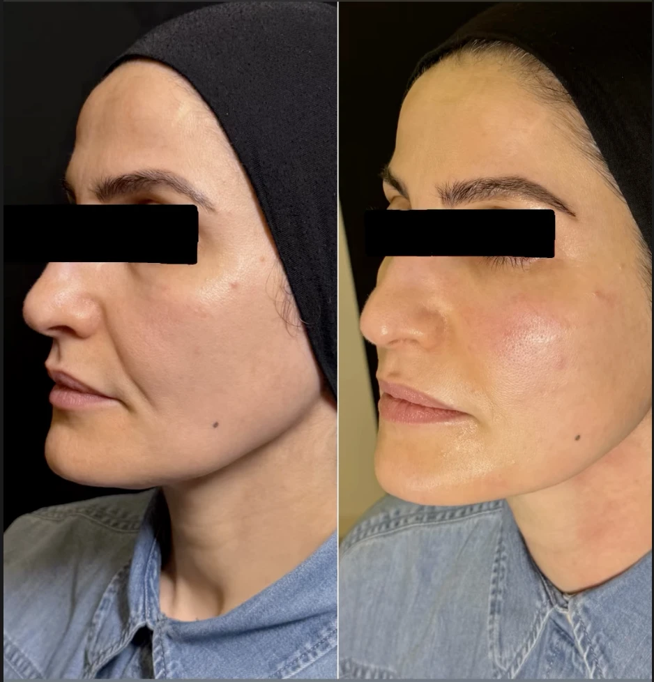 XERF before and after on the same patient, the after photograph taken immediately following a single treatment